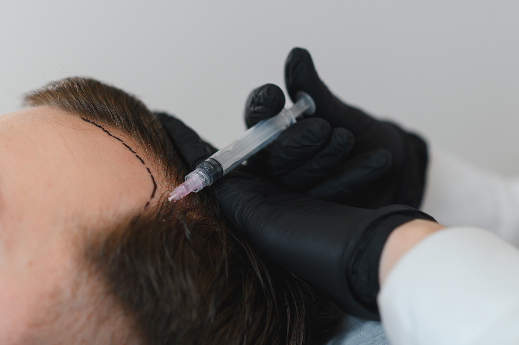 Markierung der neuen Haarlinie vor einer Haartransplantation bei Vital of Hair