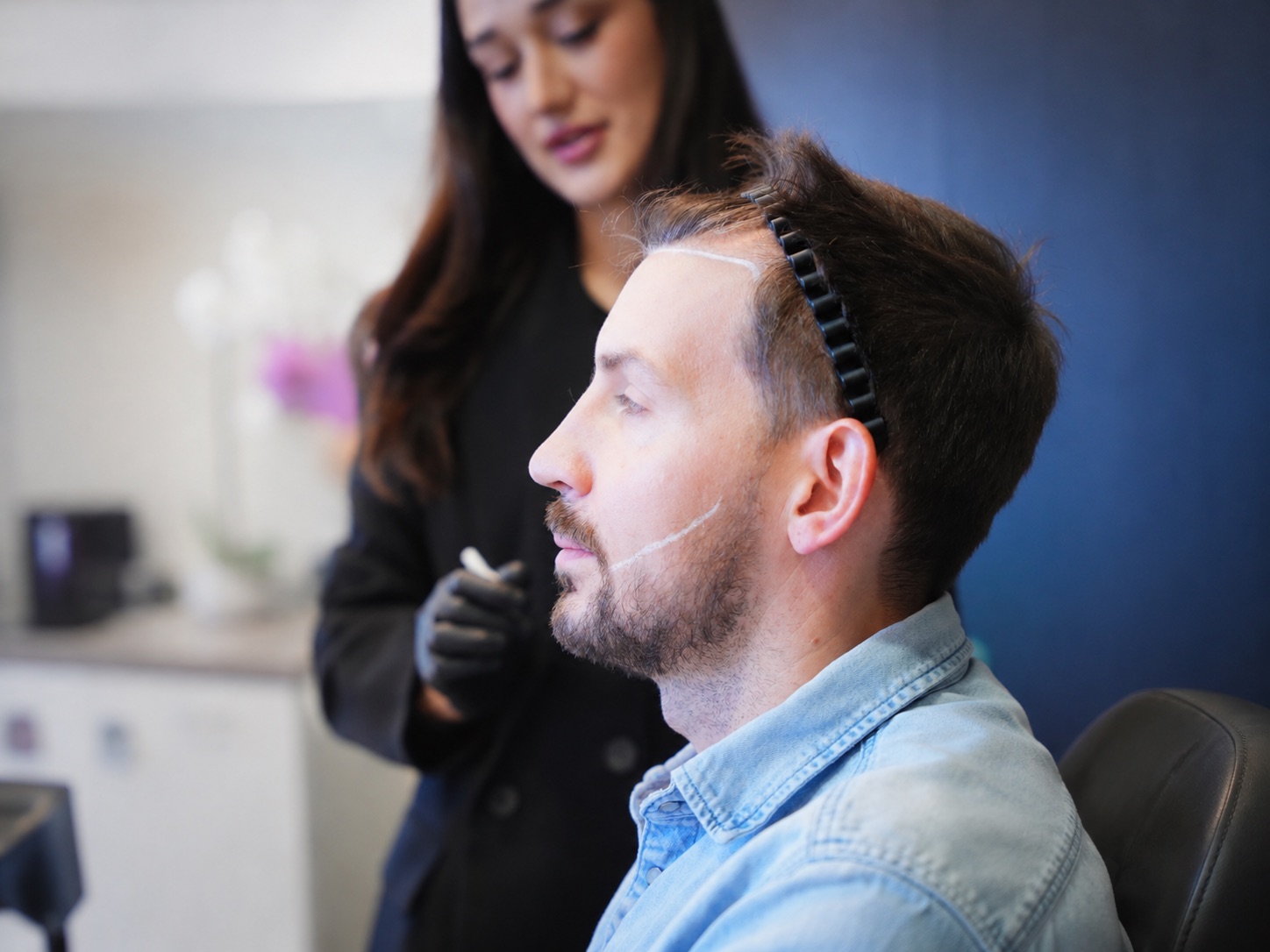 Reales Seitenprofil eines Patienten mit eingezeichneter Bartlinie vor der Barttransplantation bei Vital of Hair