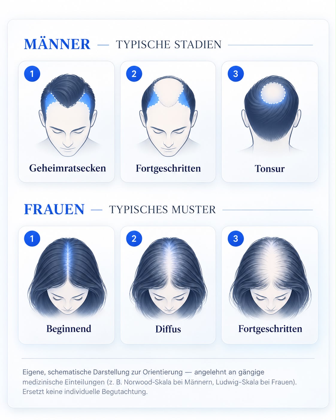 Typische Stadien des Haarausfalls bei Männern und Frauen – Orientierungsgrafik