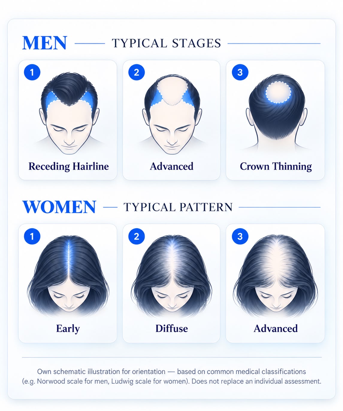 Typical stages of hair loss in men and women — reference graphic