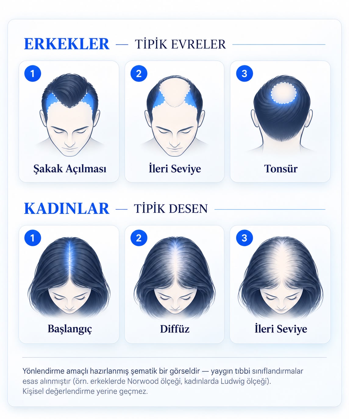 Erkeklerde ve kadınlarda saç dökülmesinin tipik evreleri — referans grafiği